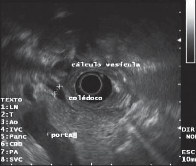 common bile duct cat. the intrahepatic ile duct