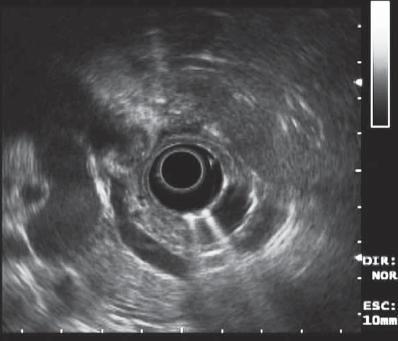 common bile duct cat. compression of common bile