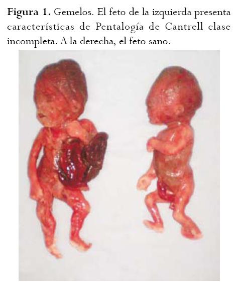 INVESTIGACION EMBARAZO GEMELAR investigacion embarazo gemelar: